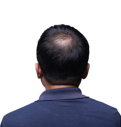 پیشگیری از ریزش مو,درمان ریزش مو,تقویت مو,ریزش مو,تونیک ضد ریزش موی بیز,تونیک بیز