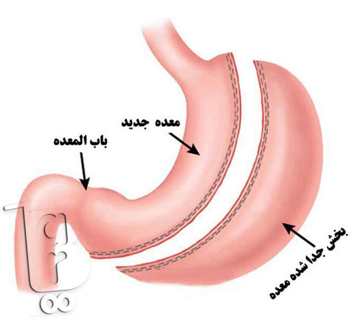 جدیدترین روش جراحی لاغری، جراحی لاغری پلیکاسیون معده، عمل لاغری با لیزر، عمل لاغری بهاره رهنما، عمل لاغری خیابانی، عوارض عمل لاغری، عوارض عمل معده برای لاغری، هزینه عمل لاغری،انواع عمل جراحی لاغری