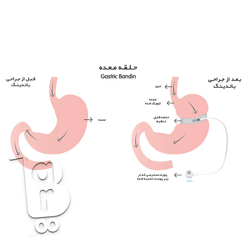 جدیدترین روش جراحی لاغری، جراحی لاغری پلیکاسیون معده، عمل لاغری با لیزر، عمل لاغری بهاره رهنما، عمل لاغری خیابانی، عوارض عمل لاغری، عوارض عمل معده برای لاغری، هزینه عمل لاغری،انواع عمل جراحی لاغری