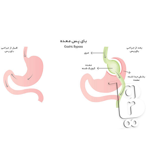 جدیدترین روش جراحی لاغری، جراحی لاغری پلیکاسیون معده، عمل لاغری با لیزر، عمل لاغری بهاره رهنما، عمل لاغری خیابانی، عوارض عمل لاغری، عوارض عمل معده برای لاغری، هزینه عمل لاغری،انواع عمل جراحی لاغری