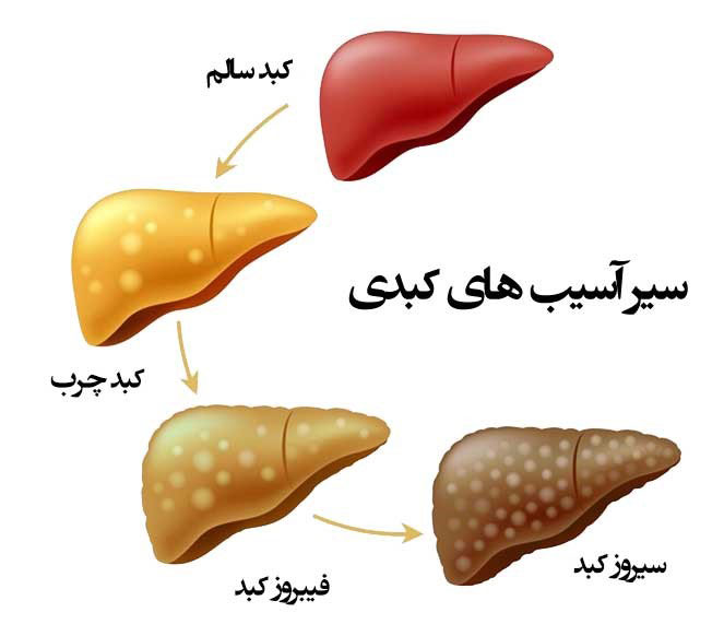 علائم کبد چرب،درمان کبد چرب،کبد چرب گراید۲،نجات کبد چرب،در مورد کبد چرب بیشتر بدانیم،علائم کبد چرب در زنان، کبد چرب گرید 2،کبد چرب گرید 3،رژیم غذایی کبد چرب،انواع کبد چرب،علائم کبد چرب حاد،علائم کبد چرب الکلی، علائم کبد چرب شدید