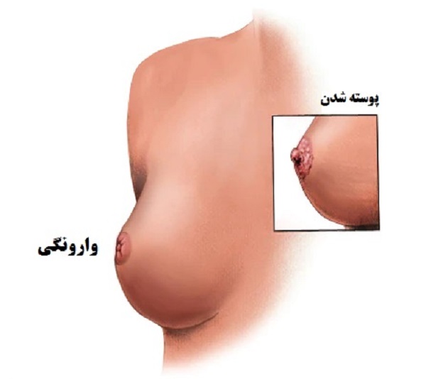 علائم سرطان پستانها در زنان،خودآزمایی سرطان سینه،عکس از سرطان،عکس سرطان سینه،تشخیص سرطان سینه در منزل،درجه بندی سرطان سینه،علائم سرطان سینه در دختر،سرطان سینه خوش خیم
