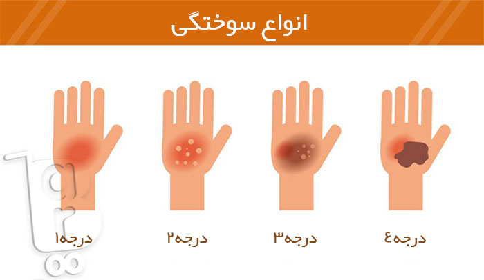 بهترین پماد سوختگی خانگی، درمان تاول سوختگی، درمان جای سوختگی، درمان خانگی سوختگی با آب جوش، درمان سوختگی با بخار، درمان سوختگی بعد از ترکیدن تاول، درمان عفونت سوختگی، سوختگی را چگونه درمان کنیم