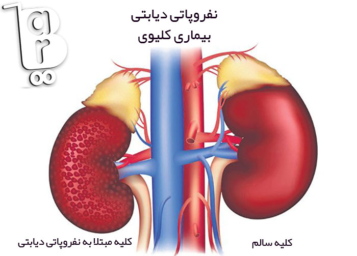 بارزترین یافته پاتولوژی در نفروپاتی دیابتی، بیماری نفروپاتی کلیه، درمان نفروپاتی دیابتی، رژیم غذایی نفروپاتی دیابتی، علت نفروپاتی دیابتی، نفروپاتی دیابتی pdf، نفروپاتی محیطی، نوروپاتی دیابتی