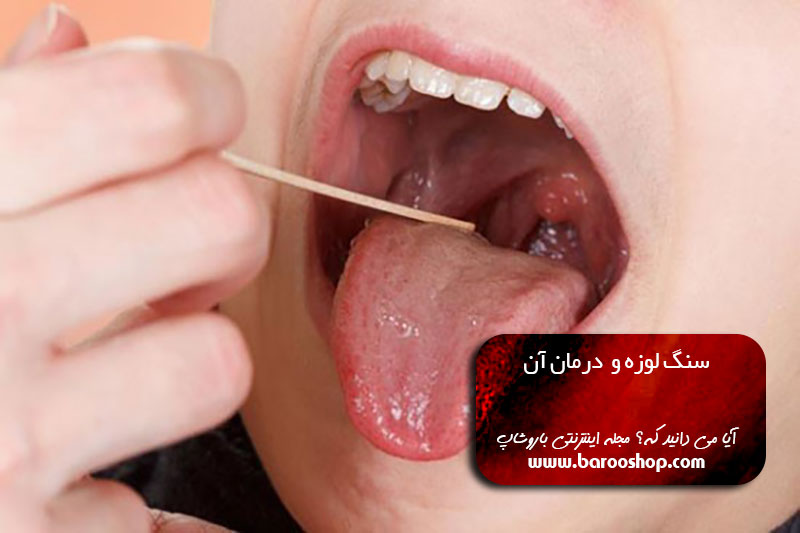 متخصص سنگ لوزه،سنگ لوزه خیراندیش،سنگ لوزه پنهان،فیلم سنگ لوزه،سنگ لوزه خطرناک است،بزرگترین سنگ لوزه،سنگ لوزه و ایدز،درمان سنگ لوزه با خاکشیر