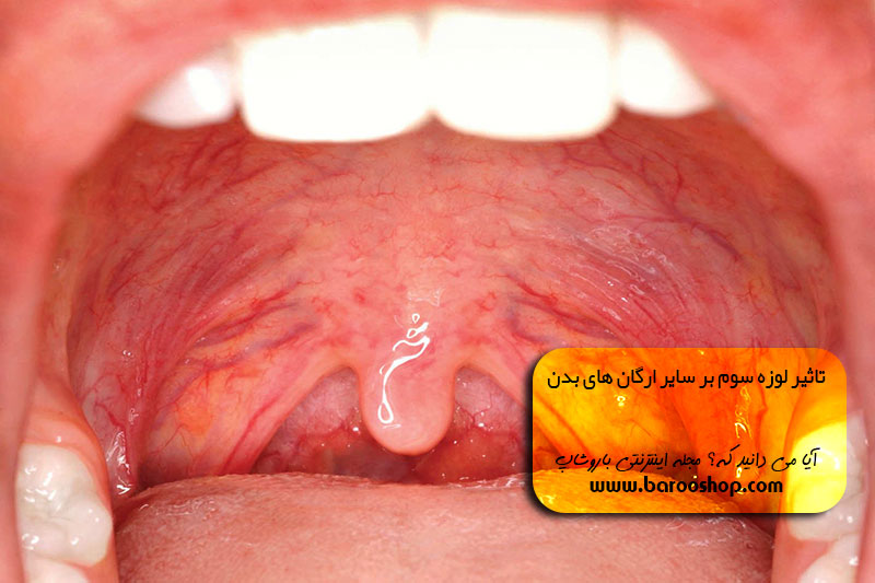 آدنوئید یا لوزه سوم،بهترین زمان برای جراحی لوزه سوم در کودکان،لوزه سوم؛ درمان دارویی یا جراحی،آیا باید لوزه سوم کودکان را عمل کنیم،لوزه و لوزه سوم،نسبت به لوزه سوم کودکان بی تفاوت نباشید
