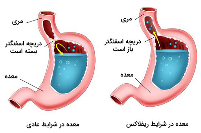 دارچین و رفلاکس معده، درمان جدید رفلاکس معده، درمان رفلاکس معده با عسل، درمان رفلاکس معده در طب اسلامی، درمان صددرصد رفلاکس معده، رفلاکس معده و تنگی نفس، علائم خطرناک رفلاکس معده، علائم رفلاکس معده چیست