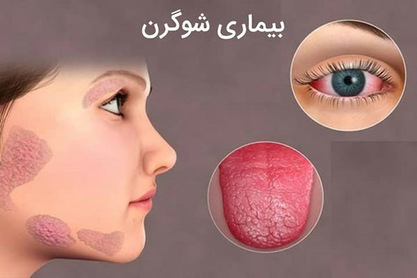 بیماری سندرم شوگرن، علائم بیماری شوگرن، عوارض بیماری شوگرن، بیماری شوگرن خطرناک است؟