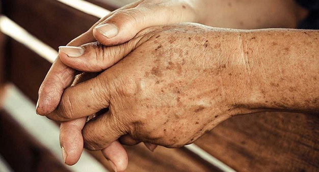 بیماری های پوستی کشنده،انواع بیماری های پوستی خارش دار،بیماری پوستی که شبیه سوختگی است،تصاویر انواع ضایعات پوستی،انواع بیماری خارشی پوست،درمان بیماری پوستی،عکس بیماری پوستی اگزما،انواع قارچ پوستی با عکس