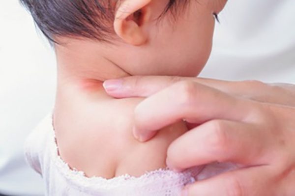 اگزمای کودکان | مجله اینترنتی باروشاپ