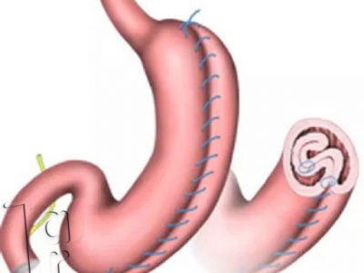 جدیدترین روش جراحی لاغری، جراحی لاغری پلیکاسیون معده، عمل لاغری با لیزر، عمل لاغری بهاره رهنما، عمل لاغری خیابانی، عوارض عمل لاغری، عوارض عمل معده برای لاغری، هزینه عمل لاغری،انواع عمل جراحی لاغری