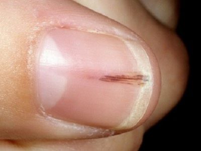 خطوط تیره زیر ناخن