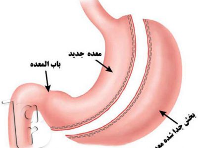 جدیدترین روش جراحی لاغری، جراحی لاغری پلیکاسیون معده، عمل لاغری با لیزر، عمل لاغری بهاره رهنما، عمل لاغری خیابانی، عوارض عمل لاغری، عوارض عمل معده برای لاغری، هزینه عمل لاغری،انواع عمل جراحی لاغری