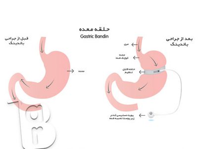 جدیدترین روش جراحی لاغری، جراحی لاغری پلیکاسیون معده، عمل لاغری با لیزر، عمل لاغری بهاره رهنما، عمل لاغری خیابانی، عوارض عمل لاغری، عوارض عمل معده برای لاغری، هزینه عمل لاغری،انواع عمل جراحی لاغری