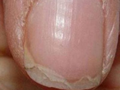 تشخیص بیماری از روی ناخن در طب سنتی،تشخیص بیماری از روی ناخن پا،تشخیص بیماری ریه از روی ناخن،بیماری ناخن،عکس ناخن ایدزی،تشخیص بیماری از روی کف دست،شیارهای عمودی روی ناخن،رنگ ناخن بیماری
