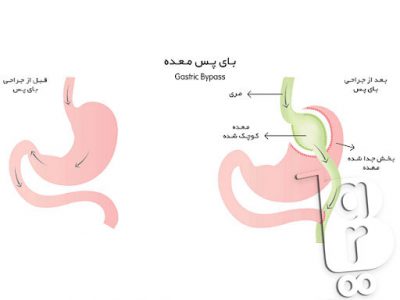 جدیدترین روش جراحی لاغری، جراحی لاغری پلیکاسیون معده، عمل لاغری با لیزر، عمل لاغری بهاره رهنما، عمل لاغری خیابانی، عوارض عمل لاغری، عوارض عمل معده برای لاغری، هزینه عمل لاغری،انواع عمل جراحی لاغری